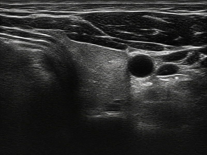Representative ultra-high-frequency superficial ultrasound image