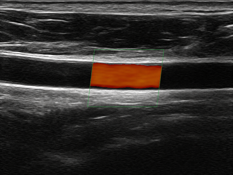 Representative vascular color ultrasound image